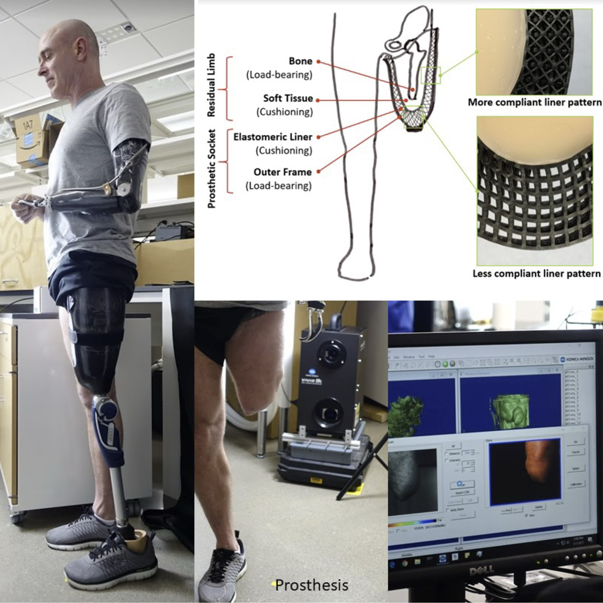 Prosthesis - Compliance-Matched 3D-Printed Elastic Liner