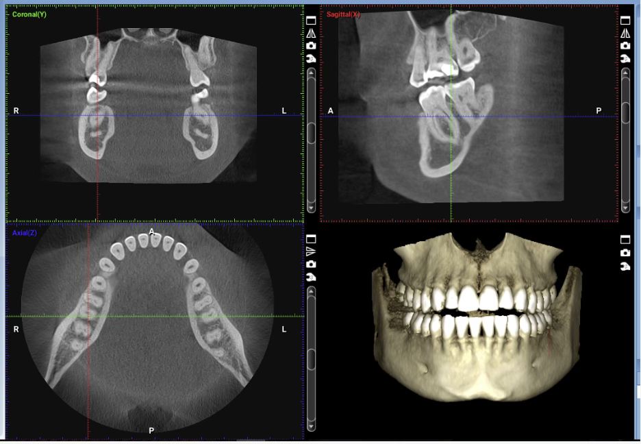 Super Resolution - CBCT Image Enhancement with μCT Ground Truth